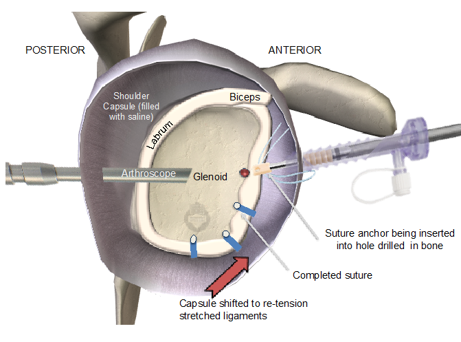 Labral Tear Shoulder Surgery Recovery Captions Nature